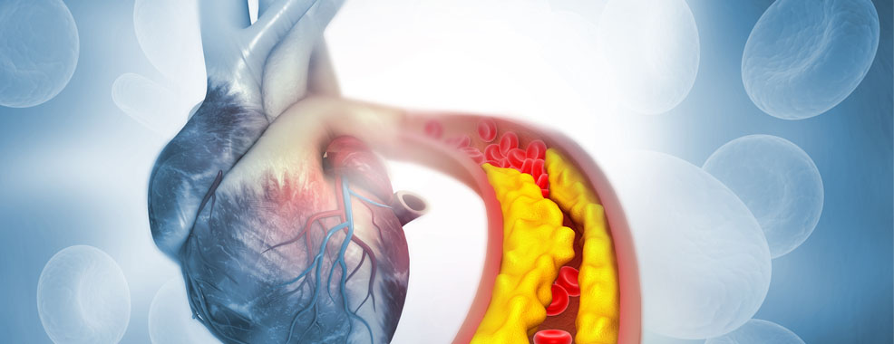 Drawing of a heart showing cholesterol buildup in a major artery.