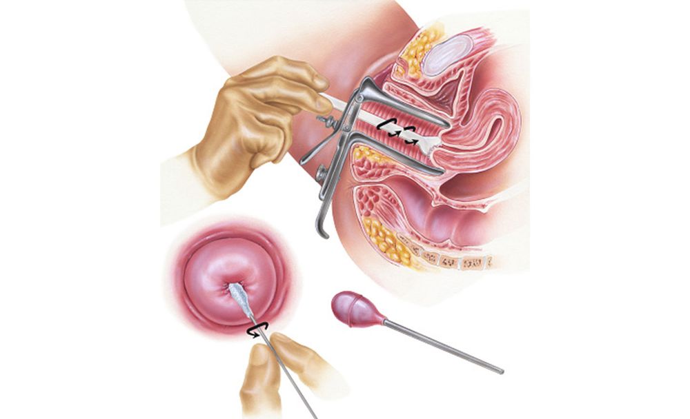Cervical Cancer Screening Illustration