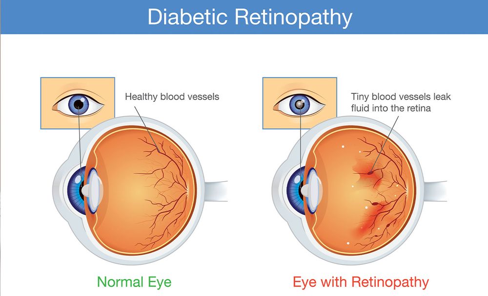 Diabetic Retinopathy Illustration