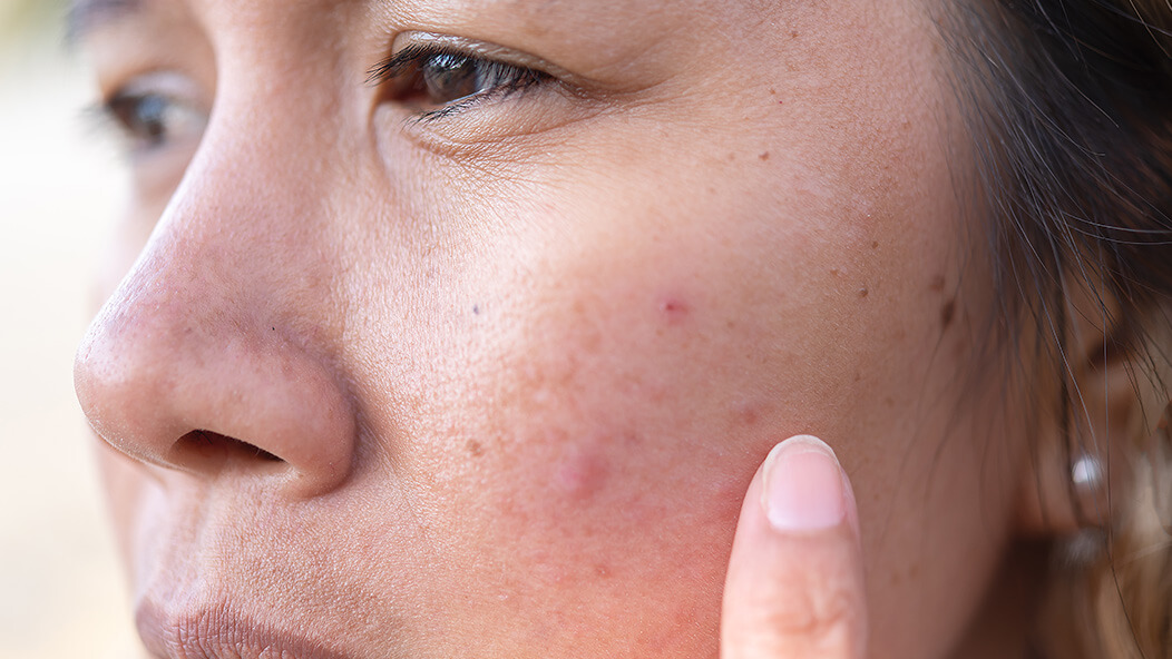 Summer acne breakout