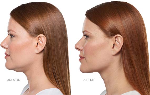 before-and-after-chin