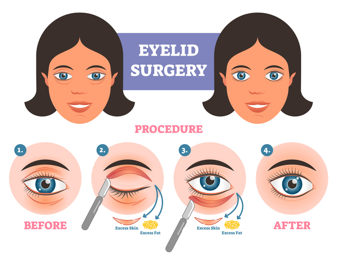 eyelid-surgery-graphic