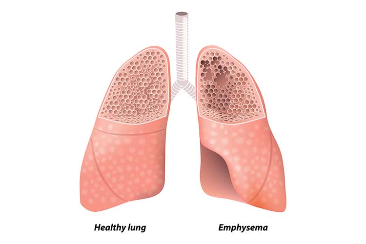 The Difference Between COPD and Emphysema