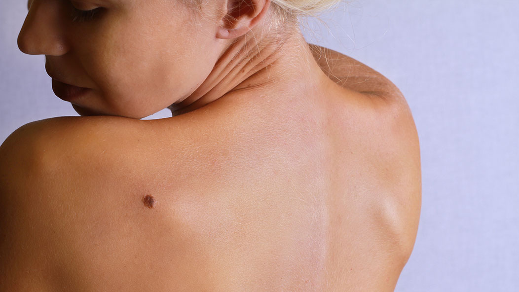 A woman examines a mole on her shoulder.