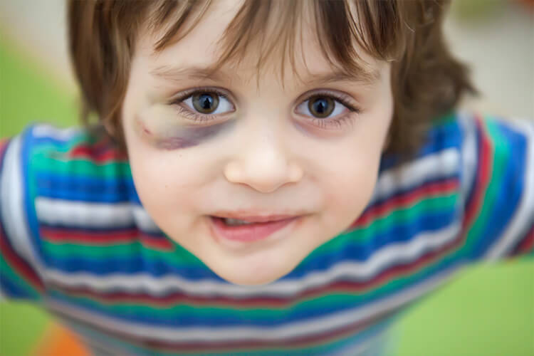 Child with a black eye