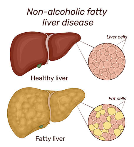 Healthy vs Fatty Liver