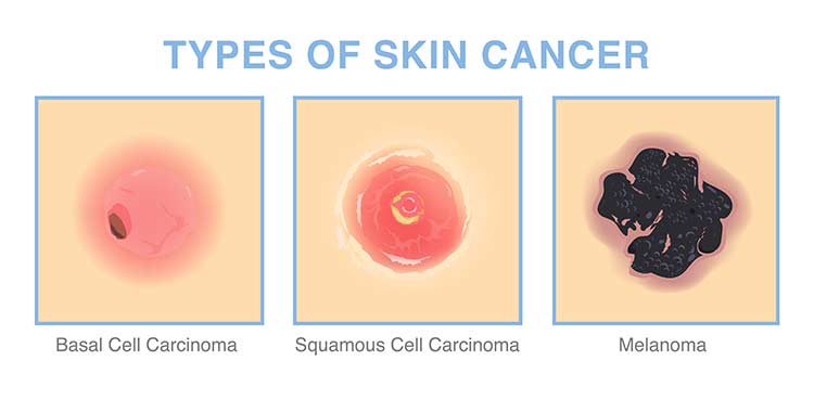 Nonmelanoma Skin Cancer