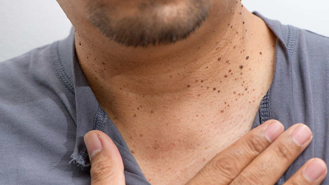 Why Do-It-Yourself Skin Tag Removal Isn’t Recommended