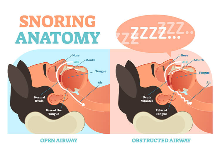 Illustration titled Snoring Anatomy showing a comparison between someone sleeping with an open airway and someone with an obstructed airway.