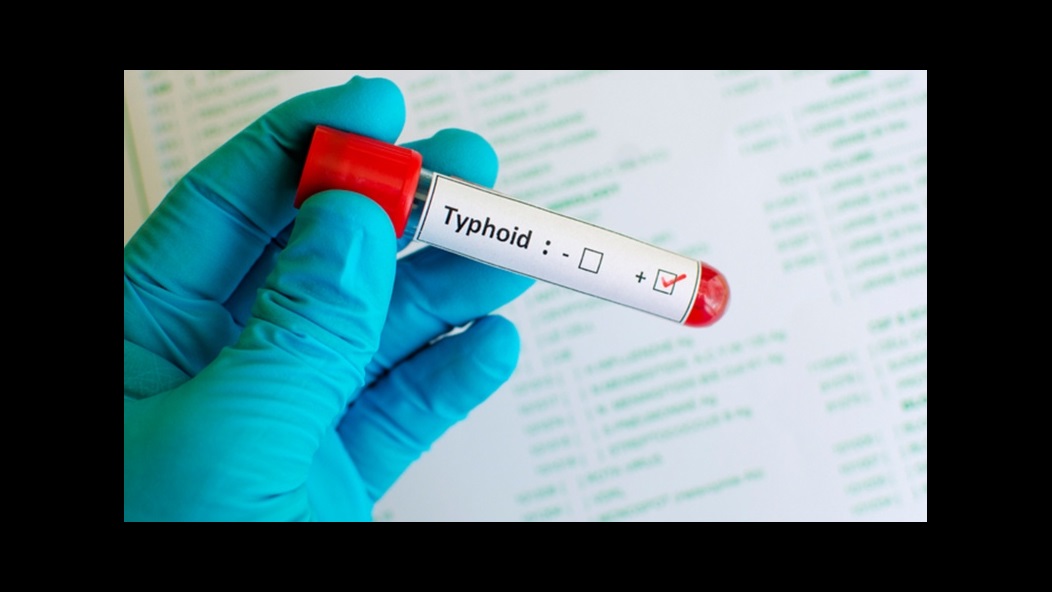 Typhoid fever