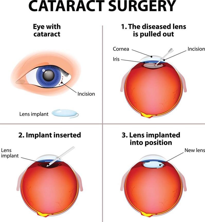 Cataract surgery illustration