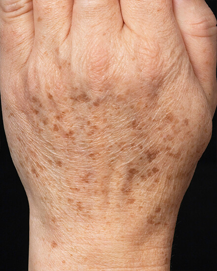 fraxel-skin-treatment-before