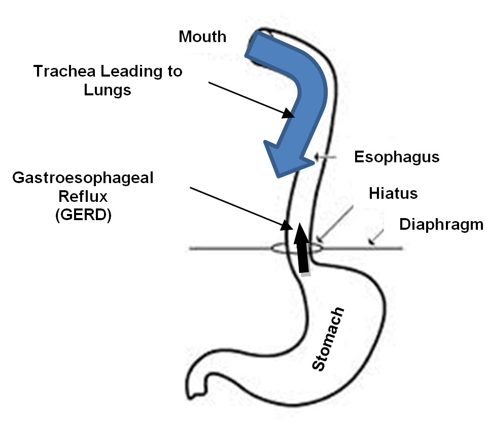 Illustration depicting the gastrointestinal system and how gastroesophageal reflux (GERD) passes up beyond the diaphragm from the stomach into the esophagus.