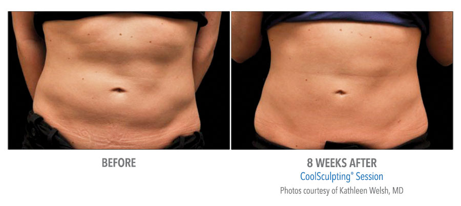 Before and After Abdomen 1