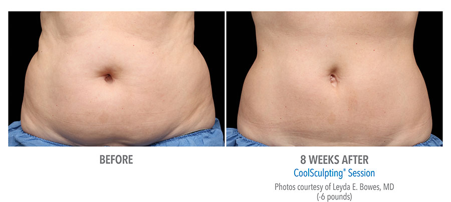 Before and After Abdomen 3