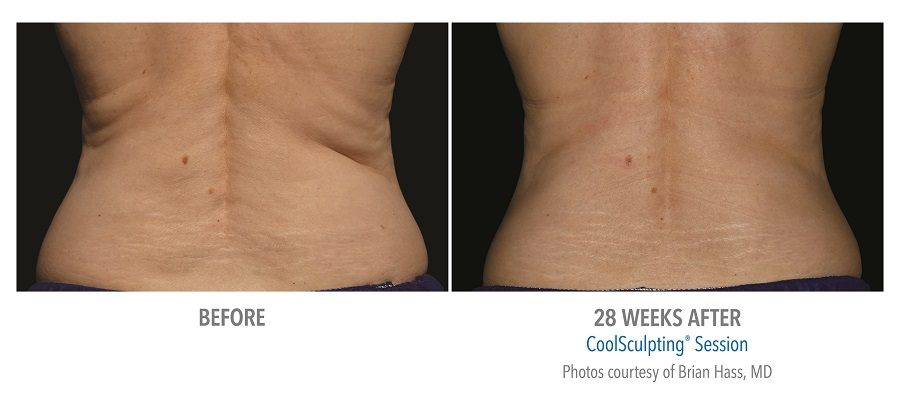 flanks before and after bariatric surgery