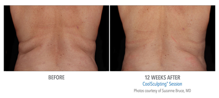 Before and After Flanks 2