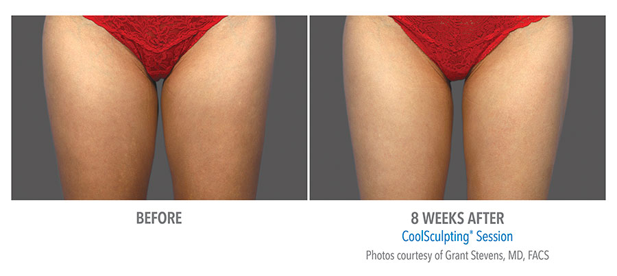 Before and After CoolSculpting  Houston - Kelsey-Seybold Clinic