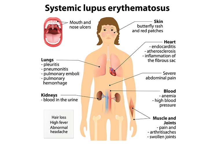 Dubunking Lupus Myths